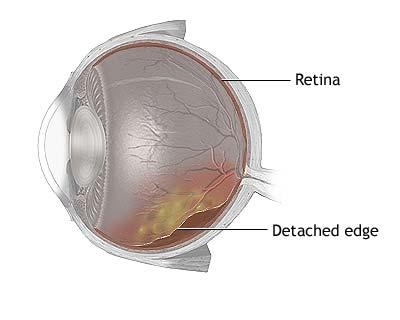 Dezlipirea de retina